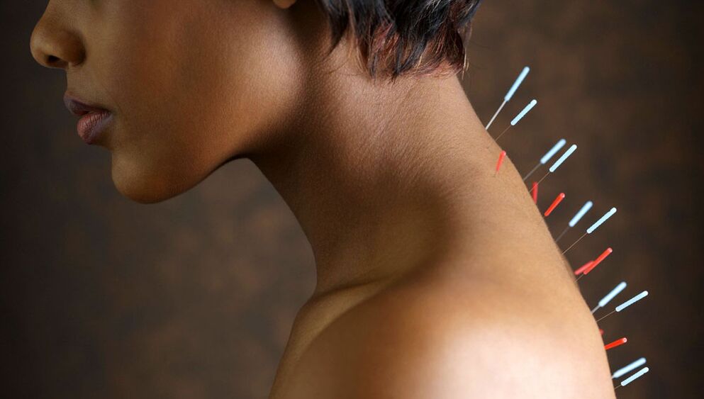 Acupuntura con osteocondrose cervical