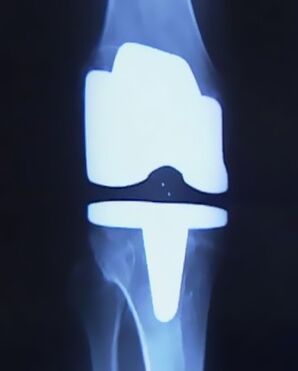 Imaxe x -ray do xeonllo cunha prótese artificial despois da operación para cambiar a articulación