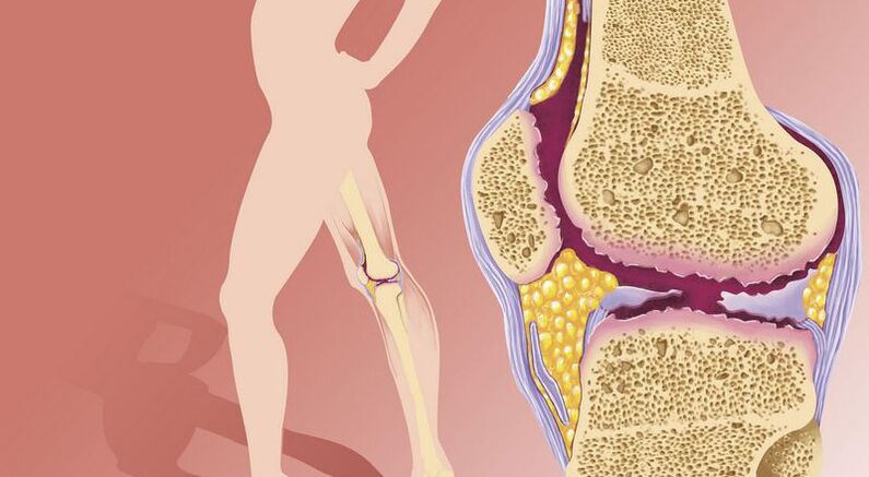 O exceso de peso leva á osteoartrite