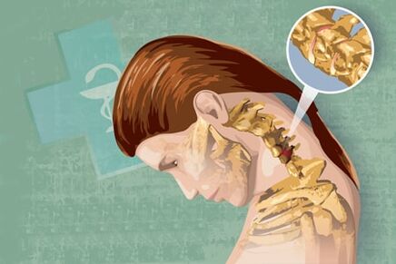 Síntomas reflexos de osteocondrose
